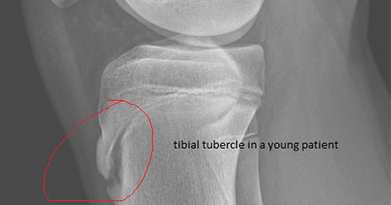 How Do You Treat Osgood-Schlatter Disease?