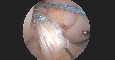 What is the Difference between ACL Repair and Reconstruction?