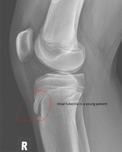 What is Osgood-Schlatter disease?